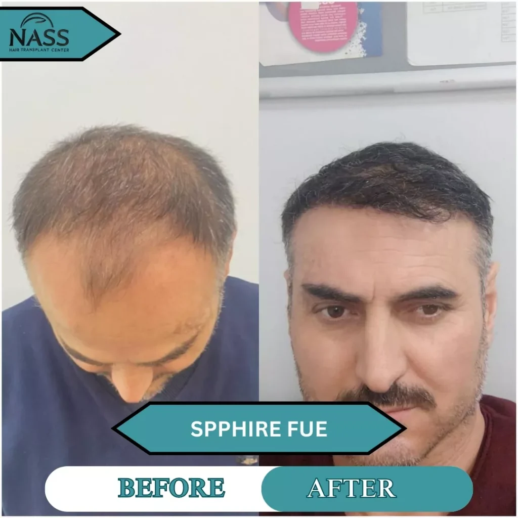 2000 grafts hair transplant cost