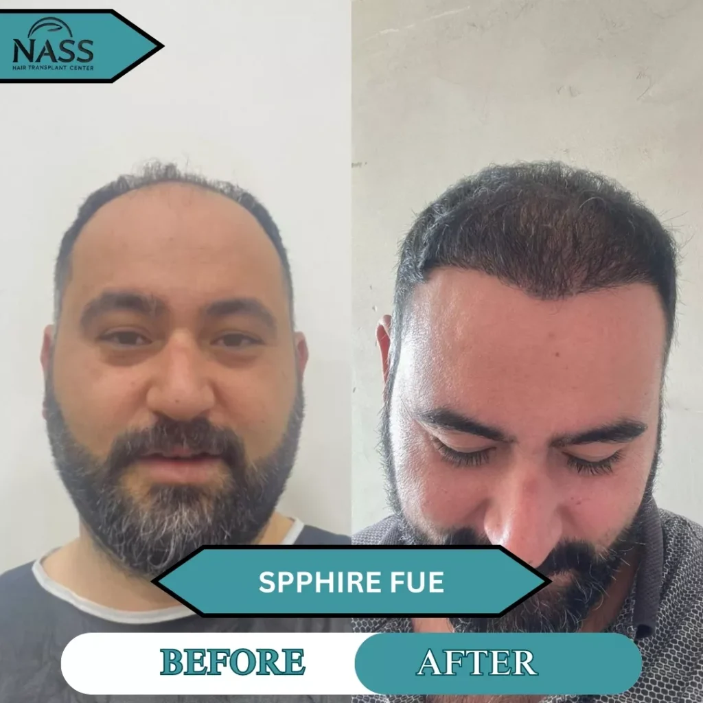 fue hair transplant turkey 3000 graft