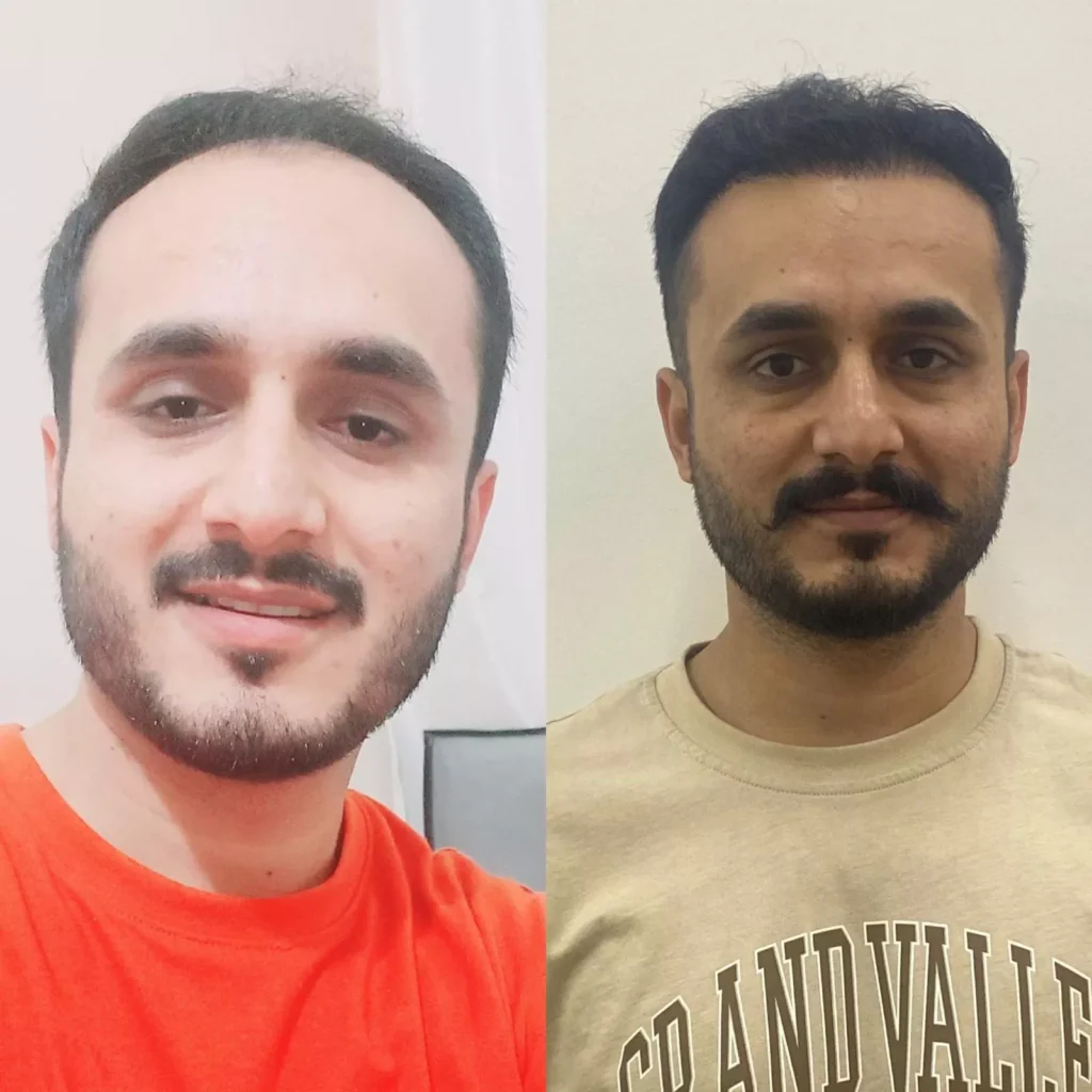 Hair Transplant Clinic Turkey