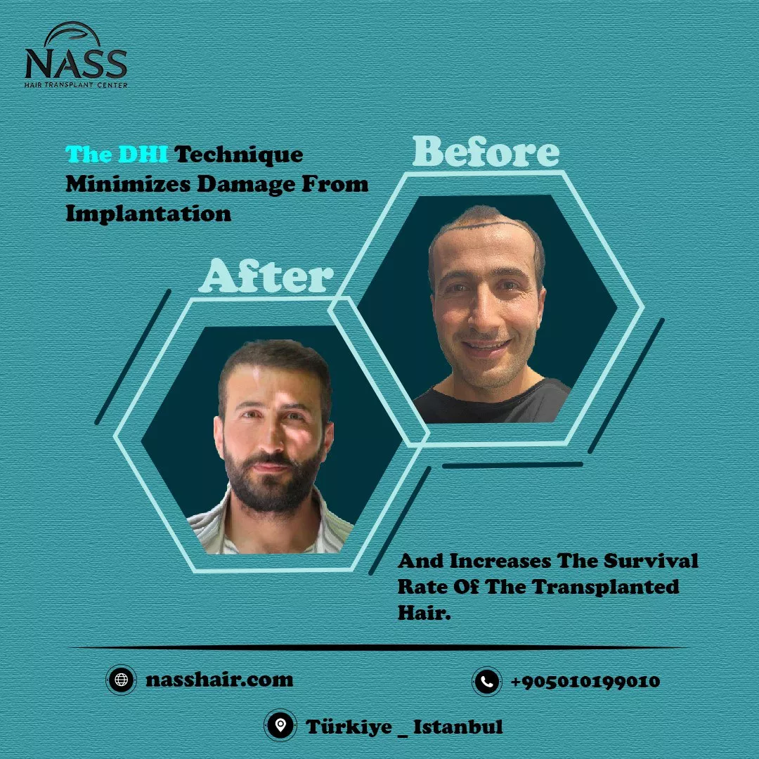 turkey hair transplant after before hair transplant