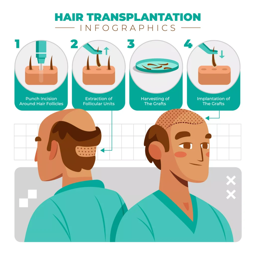 hair-transplantation