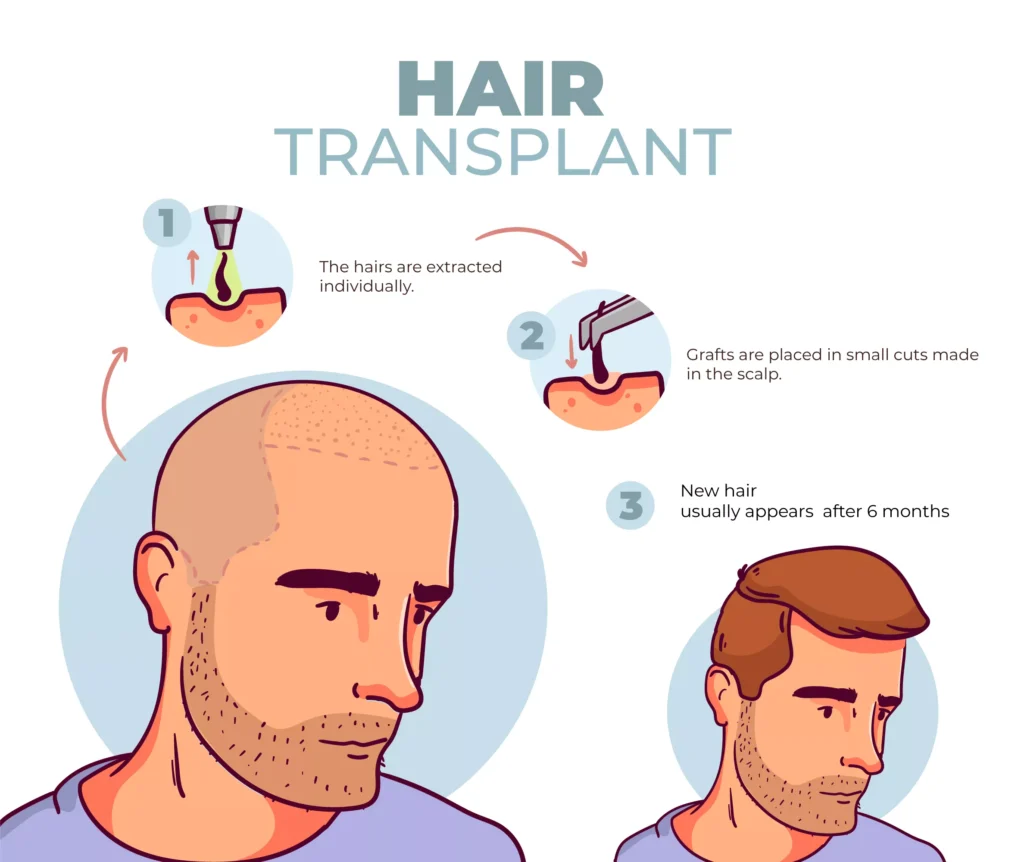 turkey hair transplant steps